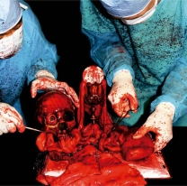 MIASMATIC NECROSIS - CD - Apex Profane