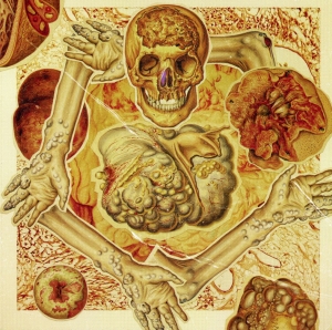 G​.​I​.​S​.​T. (Gastrointestinal Stromal Tumor​) - CD - A Postmortem Diagnosis Of Maligant Submucosal Tumors