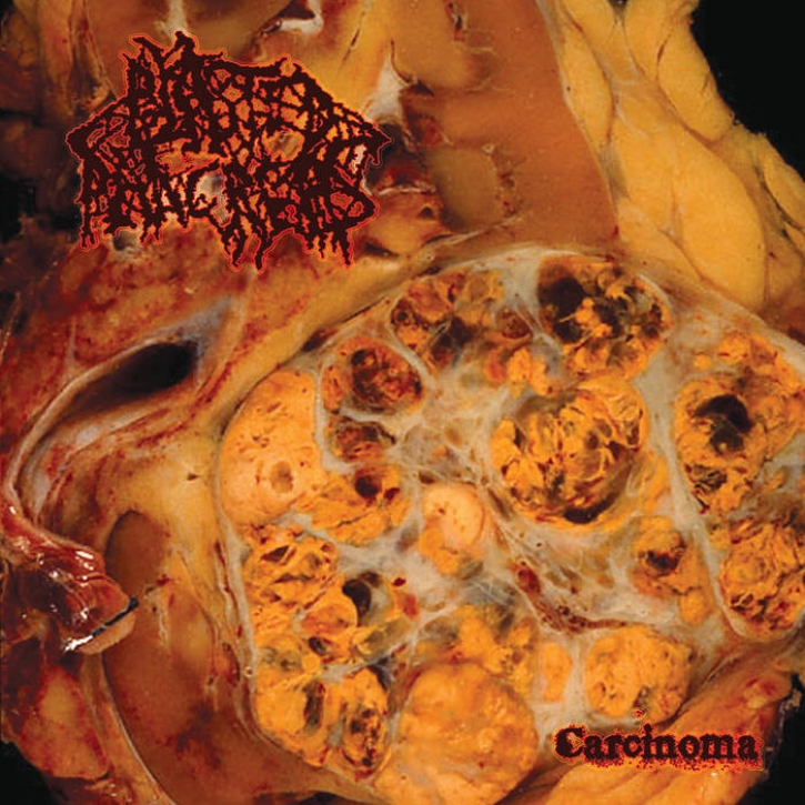 BLASTED PANCREAS - CD - Carcinoma