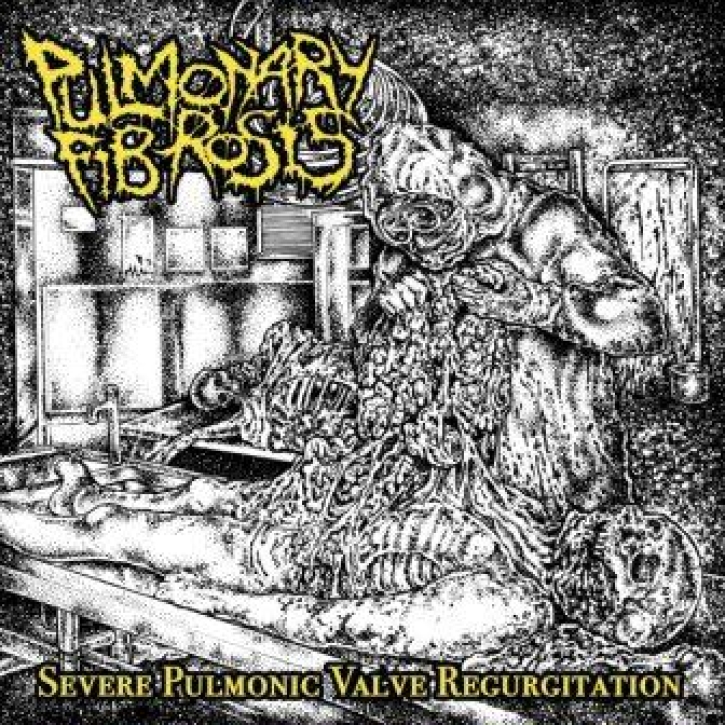 PULMONARY FIBROSIS - CD - Severe Pulmonic Valve Regurgitation