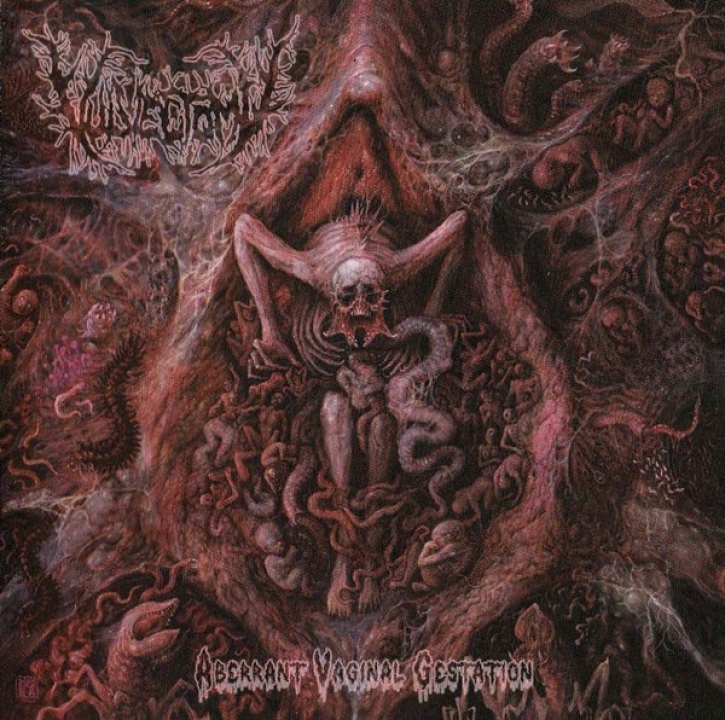 VULVECTOMY - CD - Aberrant Vaginal Gestation